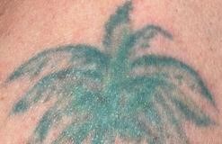What to expect when getting Laser treatment on tattoo cover-ups!!!
