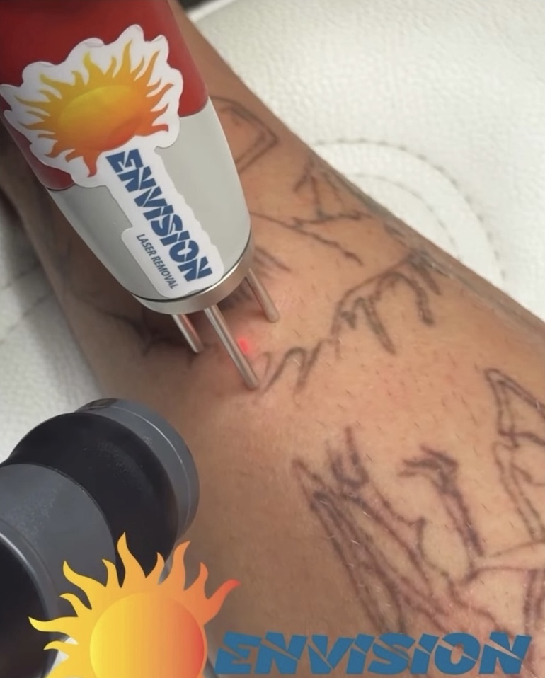 Laser tattoo removal procedure using Envision device on dark ink design with skin reaction.