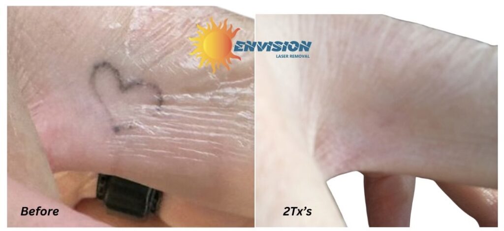 Laser tattoo removal before and after shows heart tattoo fading significantly in just two sessions.