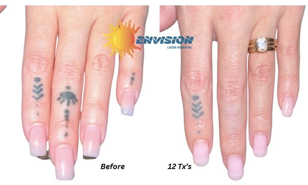 Tattoo removal progress shown in before-and-after hands after 12 laser treatments.