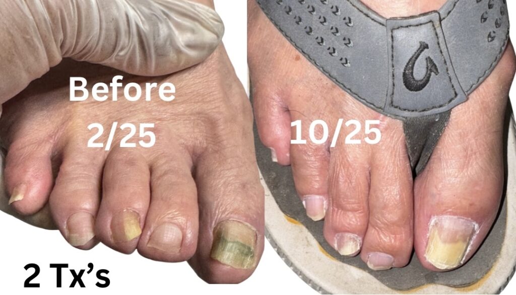 Before and after toenail treatment showing improved foot health and nail clarity.