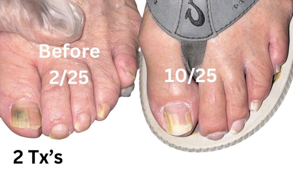 Before and after toenail treatment comparison showing improved nail health and appearance.