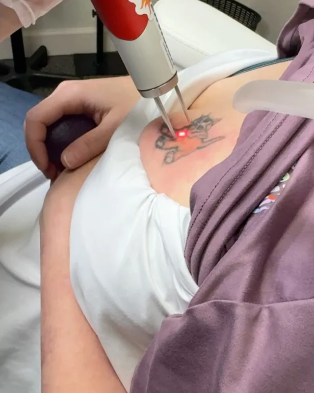 Double lasers Treated #envisionlasertattooremoval #veniceflorida #sarasota_florida #portcharlottetattooartist #fortmeyers