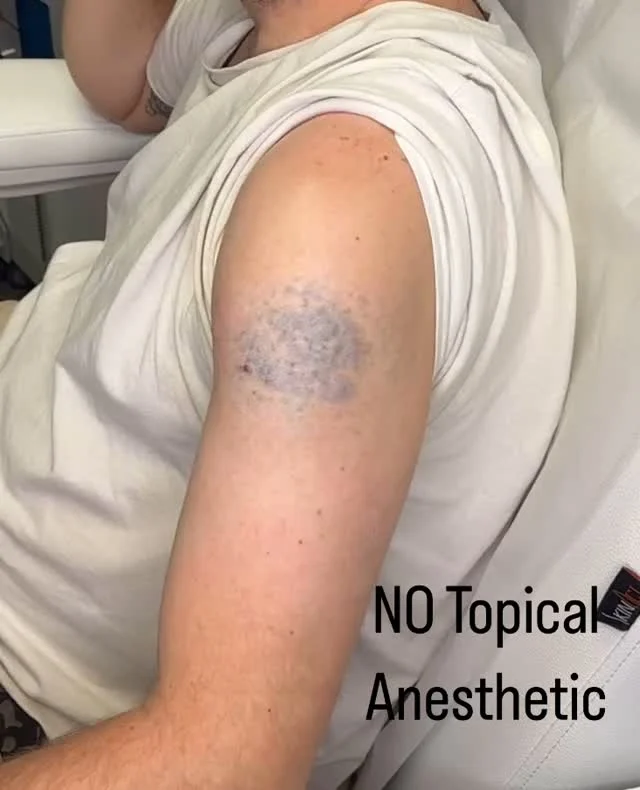 #envisionlasertattooremoval #veniceflorida #fortmeyers #sarasota #tattooremovalbeforeandafter #portcharlottefl #permanentmakeupremoval #toenailfungus #englewoodfl #servicetoothers