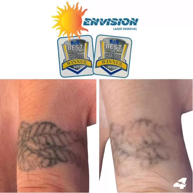 #envisionlasertattooremoval #tattooremovalbeforeandafter #veniceflorida #fortmeyers #portcharlottefl #sarasota