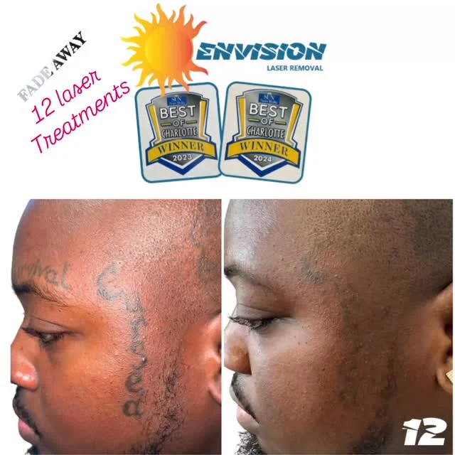 #envisionlasertattooremoval #veniceflorida #fortmeyers #sarasota #tattooremovalbeforeandafter