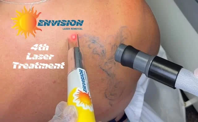 4th Laser Treatment #envisionlasertattooremoval #fortmeyers #sarasota #veniceflorida #tattooremovalbeforeandafter #tattooremovalbeforeandafter