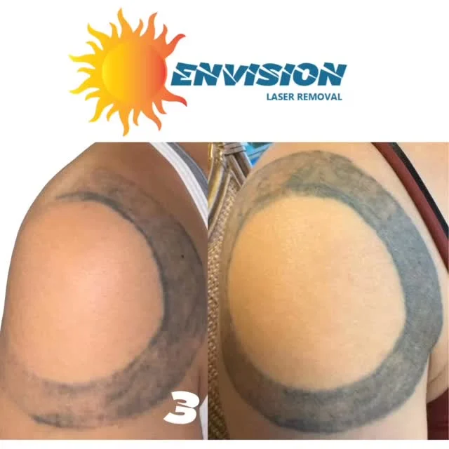 3 laser treatments #envisionlasertattooremoval #sarasota #veniceflorida #fortmeyers #capecoralflorida #portcharlottefl