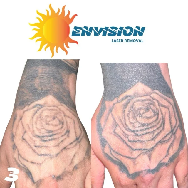 3 Laser Treatments #envisionlasertattooremoval #veniceflorida #beforeandaftertattoo #portcharlottefl #fortmeyers #northportfl