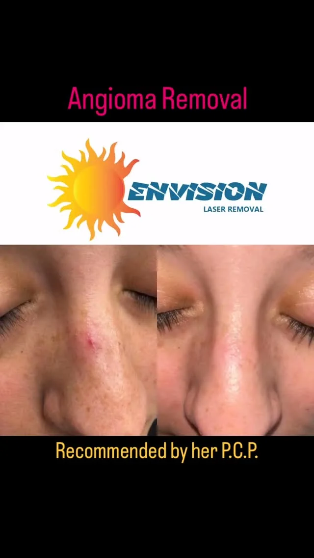 Angioma Removal In a couple of treatment.  #envisionlaserremoval #angioma #skinblemishes