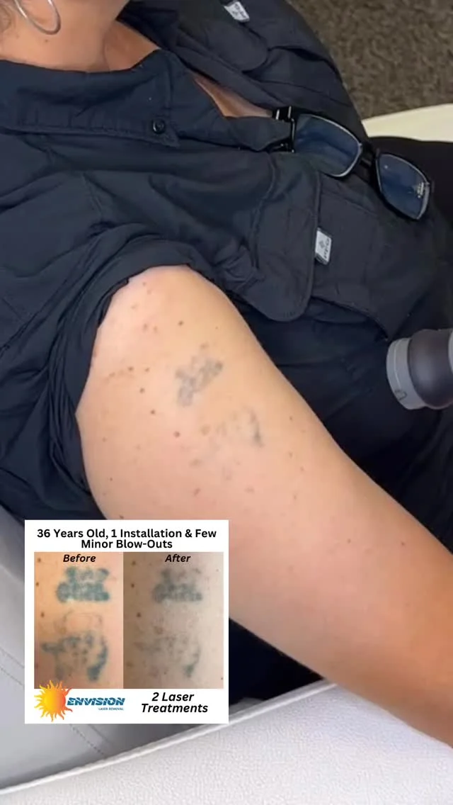 We are grateful, our patient, and customers chose us!  Thank you 🙏🏼🙏🏾. #envisionlasertattooremoval #veniceflorida #sarasota #fortmeyers #tattooremovalbeforeandafter #portcharlottefl #permanentmakeupremoval #toenailfungus #servicetoothers