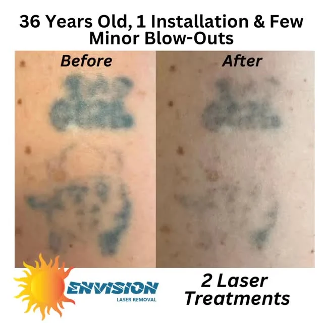 We are grateful, our patient, and customers chose us!  Thank you 🙏🏼🙏🏾. #envisionlasertattooremoval #veniceflorida #sarasota #fortmeyers #tattooremovalbeforeandafter #portcharlottefl #permanentmakeupremoval #toenailfungus #servicetoothers