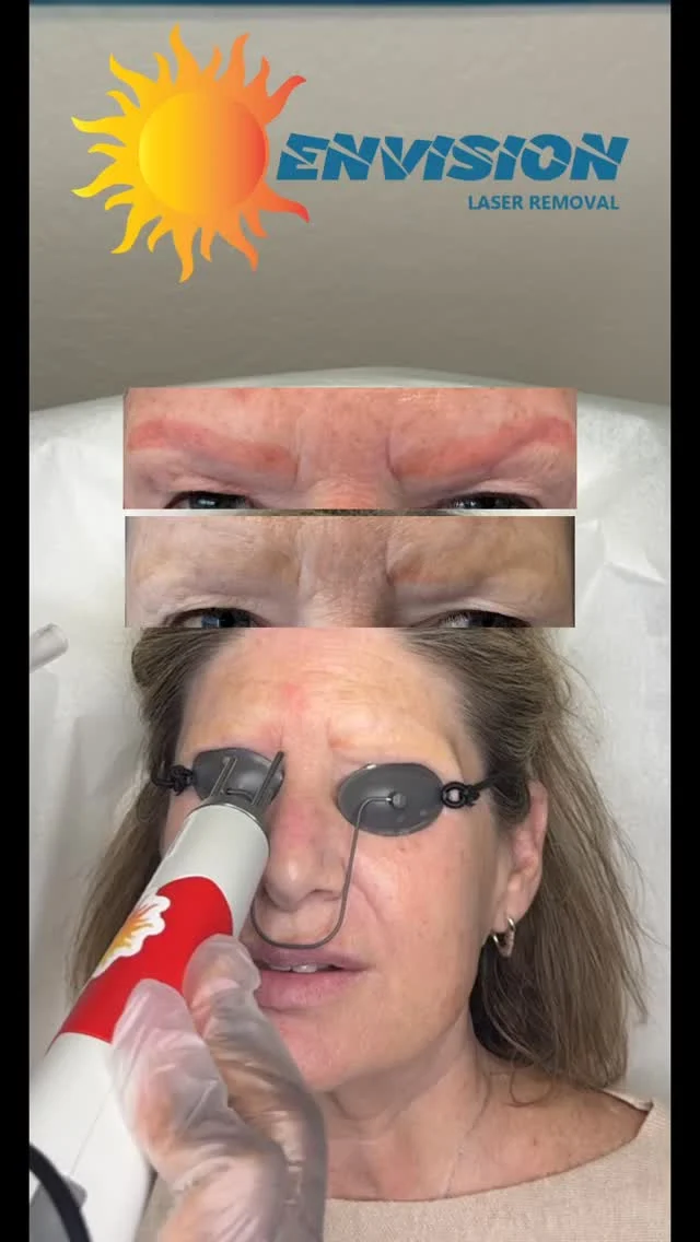 Couple of #permanentmakeupartist Laser Treatments Skin Type III amazingly.  The first wants a reset and the second request back to natural. #envisionlasertattooremoval #portcharlottefl #veniceflorida #tattooremovalbeforeandafter