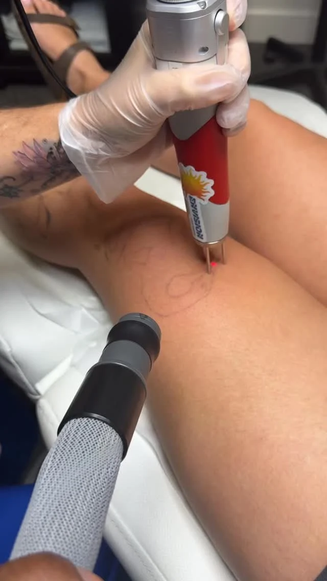 Multiple Tattoos leg treatment fading and full removal. #envisionlasertattooremoval #portcharlottefl #permanentmakeupremoval #sarasota #englewoodfl #veniceflorida #puntagordafl #northportfl #capecoralflorida #arcadiafl #fortmeyers #naples_fl #esteroflorida #bonitaspringsfl