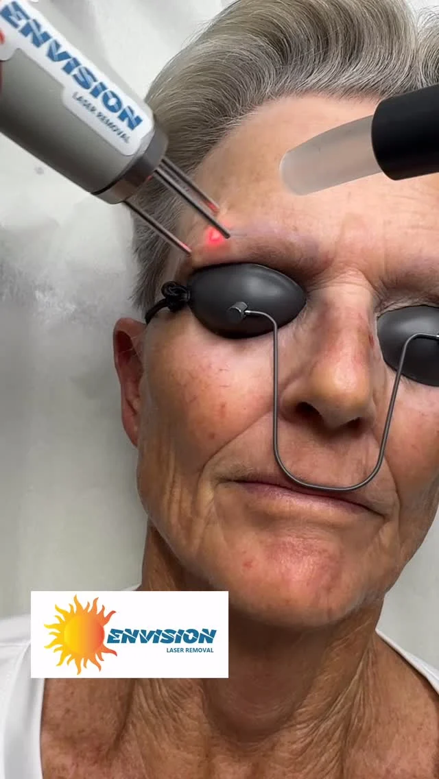 A few #eyebrows removal treatments to remove #permanetmakeup .  @
#envisionlasertattooremoval #portcharlottefl #portcharlottefl #sarasota #veniceflorida #fortmeyers #englewoodfl #northportfl