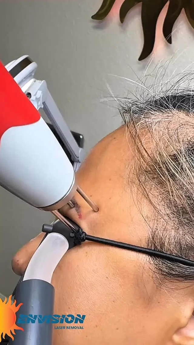 A #permamentmakeup 3 year old MISTAKE on the left eyebrow tail. She wants us to shorten the tail.  Here we use two lasers to start the process.  The first laser Tx is for “BLACK” ink and the second Tx is “RED” ink.  Skin type is essential to conduct this procedure. Among other pretreatment analysis.  #envisionlasertattooremoval #permanentmakeupremoval #portcharlottefl #fortmeyers