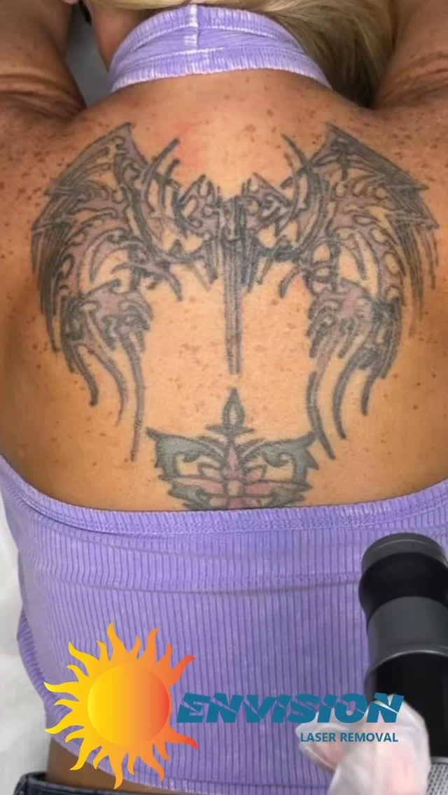 A few #tattoo Removal Treatments on fresh tattoos.  #envisionlasertattooremoval #veniceflorida #portcharlottefl #tattooremovalbeforeandafter