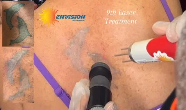 9th Laser Treatment.  Does Laser Tattoo Removal Hurt?  What is your opinion?  #envisionlasertattooremoval #portcharlottefl #capecoralflorida #fortmeyers #sarasota