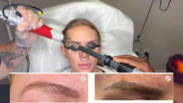 1st and maybe last laser treatment for #permanentmakeup -Removal  #envisionlasertattooremoval #veniceflorida #portcharlottefl #sarasota