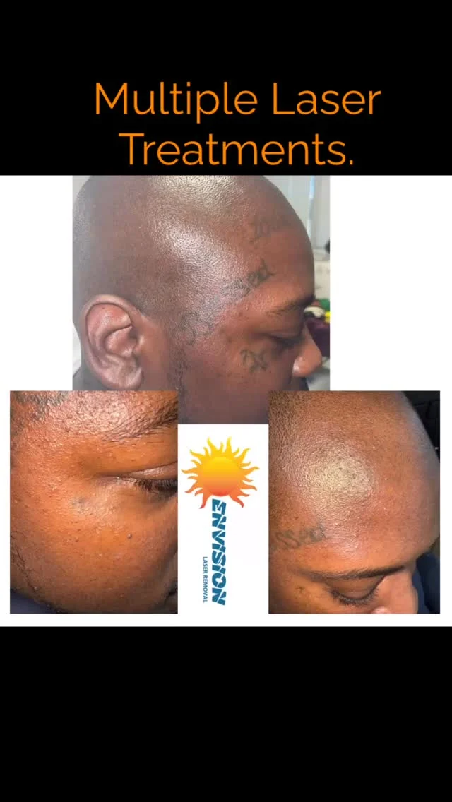 Multiple laser #tattoo treatments in progress.  We love helping people. 🥰 💗#envisionlasertattooremoval #portcharlottefl #portcharlottefl #veniceflorida