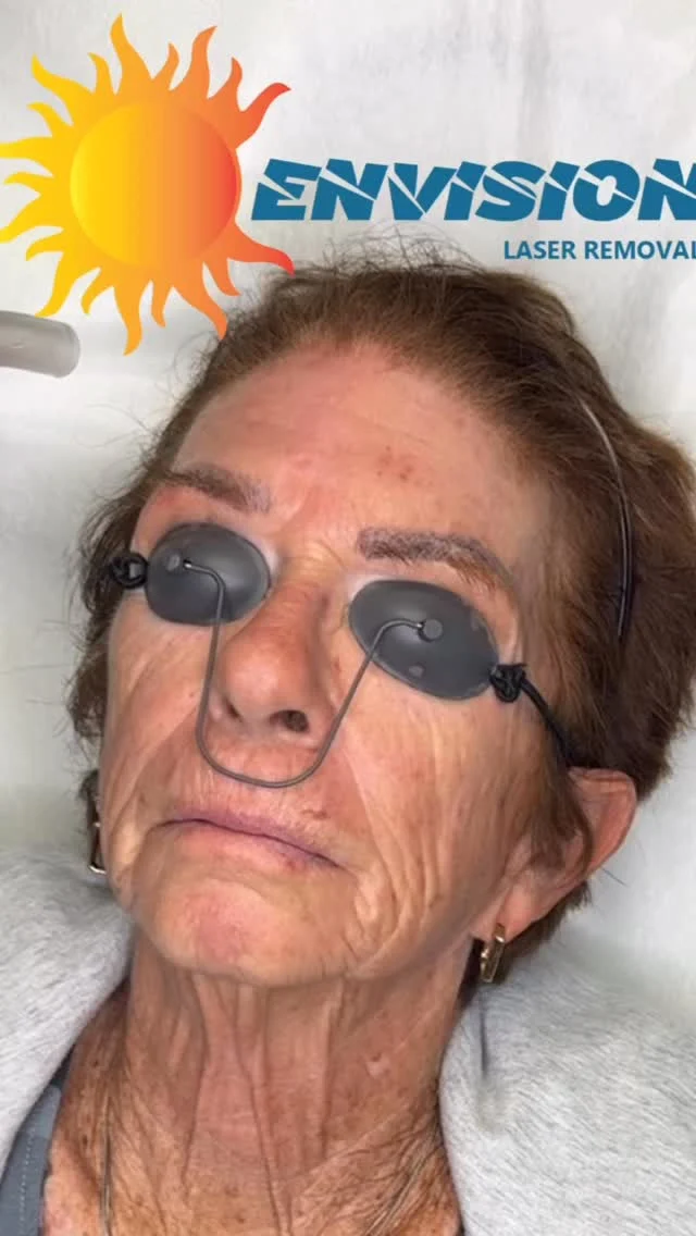 First laser Treatment and done ✅ 🏁#permanentmakeupremoval #envisionlasertattooremoval #sarasota  #portcharlottefl  #veniceflorida