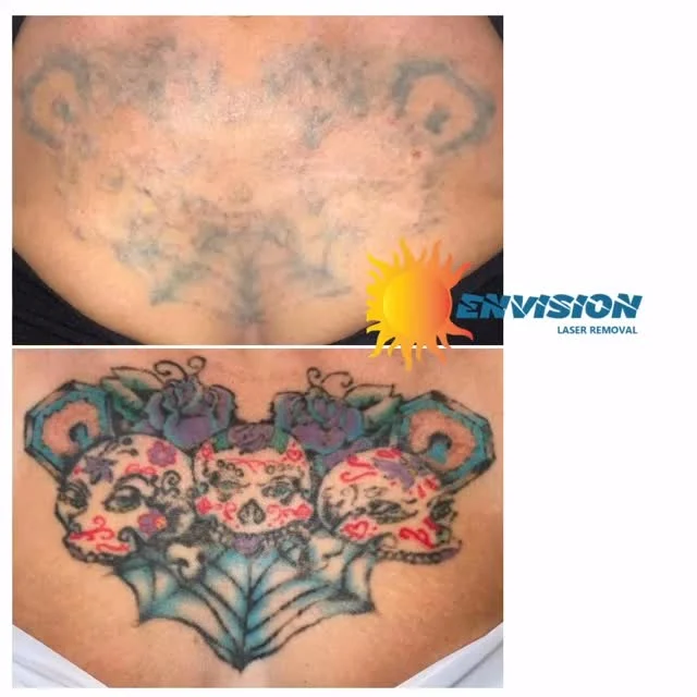 10 laser treatments and Kudos to our patient “M.K”, we have been working with her since May 2022. Sometimes it’s a journey for many reasons; but, she wants to put this memory behind her.  Thanks for trusting @envision_laser_removal  MK🥰💐. #envisionlasertattooremoval #tattooremovalbeforeandafter #portcharlottefl #sarasota #veniceflorida