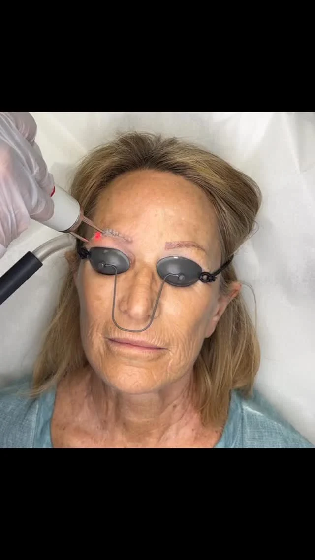 #envisionlasertattooremoval #portcharlottefl #capecoralflorida #permanentmakeupremoval #sarasota