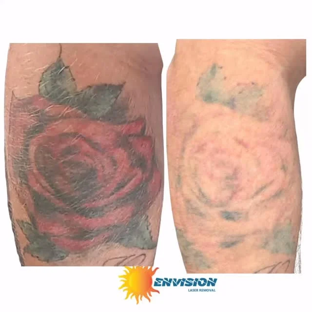 #envisionlasertattooremoval #tattooremovalbeforeandafter #portcharlottefl #sarasota #fortmeyers