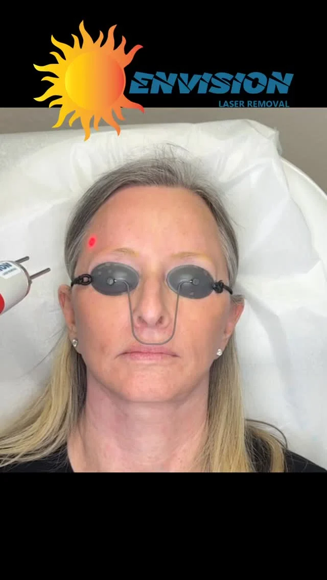 #envisionlasertattooremoval #permanentmakeupremoval #veniceflorida #portcharlottefl #fortmeyers