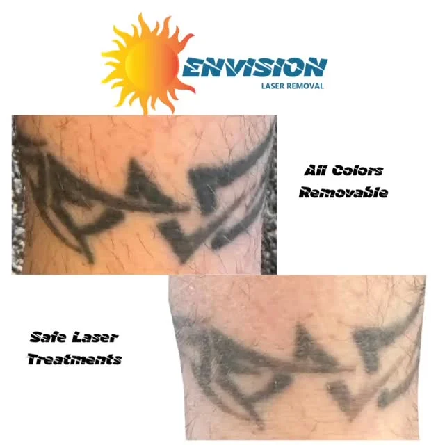 #envisionlasertattooremoval #tattooremovalbeforeandafter #portcharlottefl #sarasota #veniceflorida