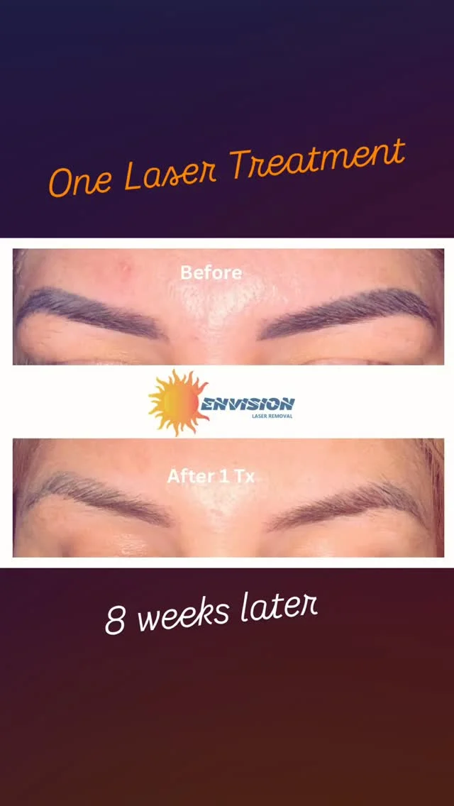 One Laser Treatment and 8weeks Later.  #envisionlasertattooremoval #portcharlottefl #permanentmakeupremoval #sarasota #veniceflorida