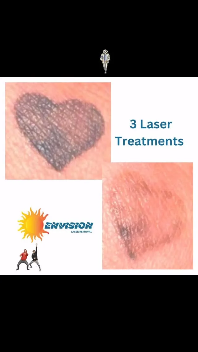This is really exciting work. Helping people remove artwork. #envisionlasertattooremoval #portcharlottefl #tattooremovalbeforeandafter #sarasota #fortmeyers