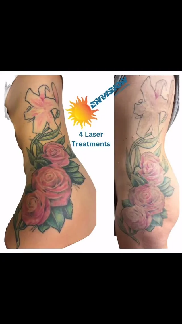 4 Laser Treatments #envisionlasertattooremoval #portcharlottefl #sarasota #fortmeyers #veniceflorida