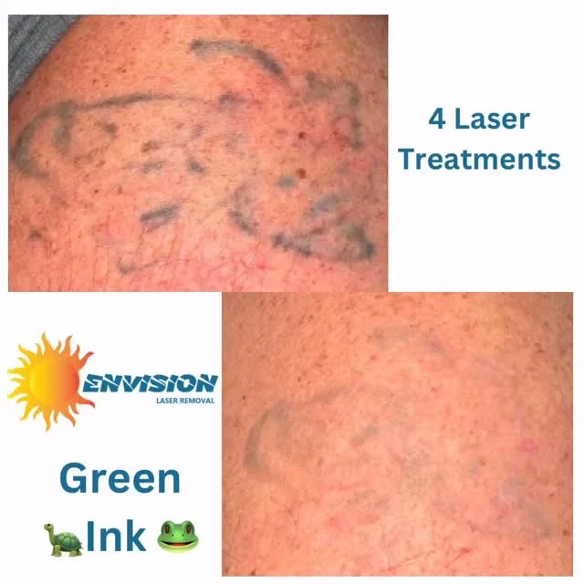#envisionlasertattooremoval #portcharlottefl #veniceflorida #sarasota #tattooremovalbeforeandafter