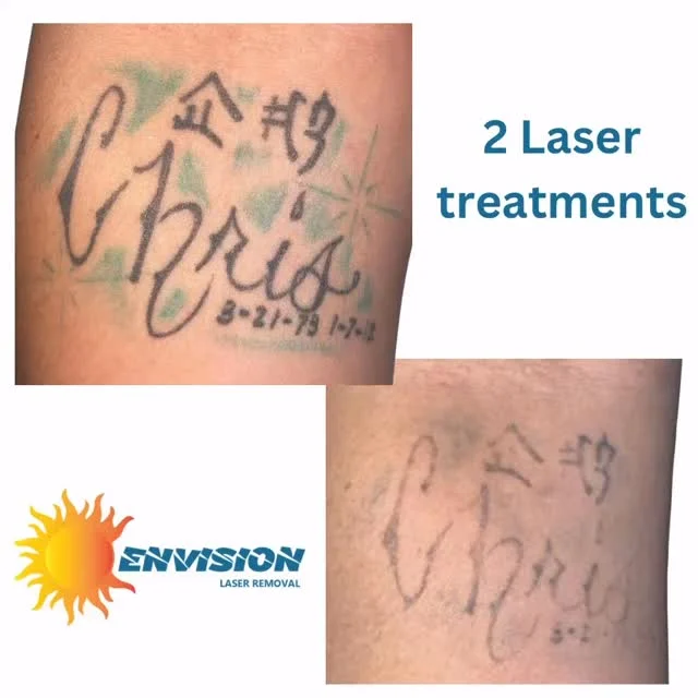#envisionlasertattooremoval #tattooremovalbeforeandafter #portcharlottefl #sarasota
