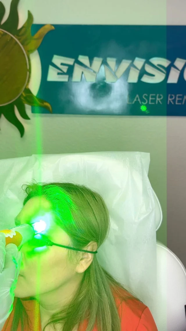 2nd laser treatment “BLACK ⚫️& BROWNISH-RED 🟤-🔴.“ 2 lasers were used for this laser treatment sequence, saving cost and is effectively reducing the overall number cycles necessary to remove all ink safely. #envisionlasertattooremoval #portcharlottefl #sarasota #capecoralflorida #northportfl