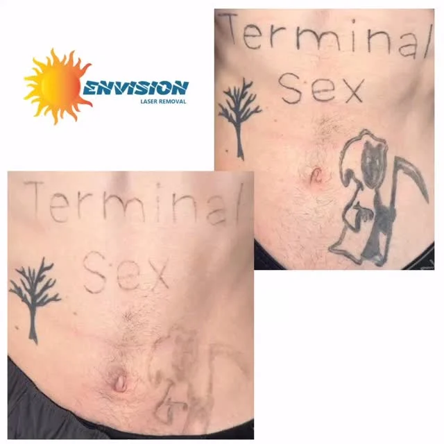 #envisionlasertattooremoval #tattooremovalbeforeandafter #portcharlottefl #sarasota #englewoodfl