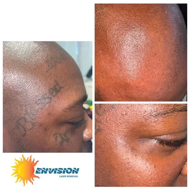 This patient has maybe 1 or 2 more laser treatments to remove his requested tattoos.  #envisionlasertattooremoval #portcharlottefl #capecoralflorida #sarasota #veniceflorida