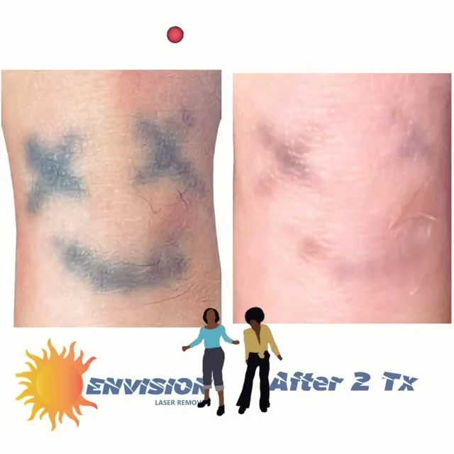 #envisionlasertattooremoval #portcharlottefl #capecoralflorida #sarasota #northportfl
