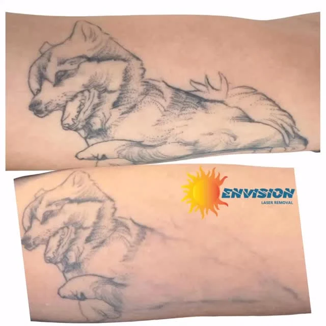 #envisionlasertattooremoval #tattooremovalbeforeandafter #portcharlottefl