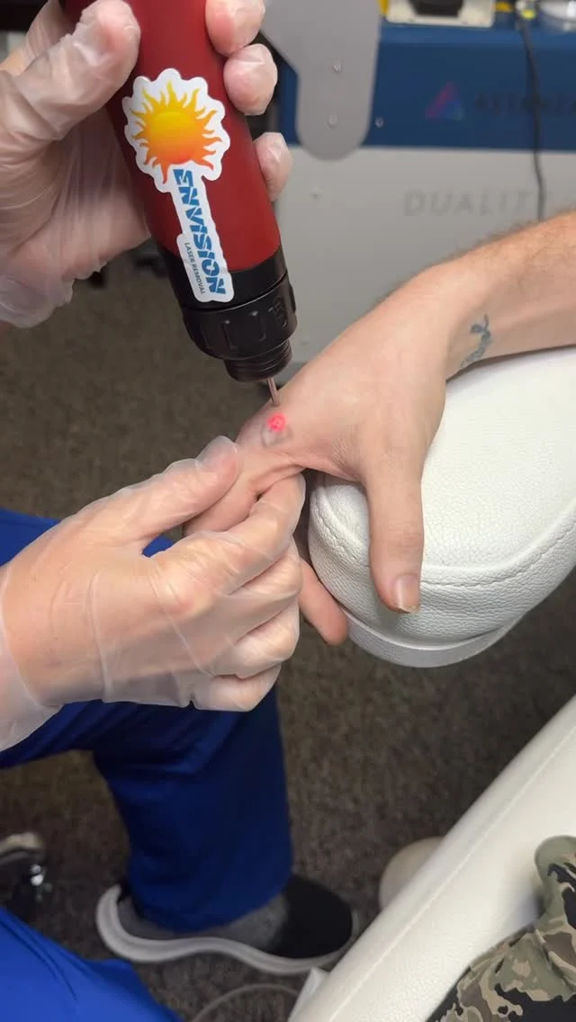 He’s head to the military 🇺🇸🫡#envisionlasertattooremoval #tattooremovalbeforeandafter #permanentmakeupremoval #toenailfungus #portcharlottefl