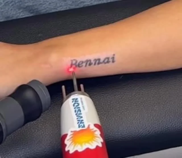 #envisionlasertattooremoval #portcharlottefl #tattooremovalbeforeandafter #sarasota #capecoralflorida