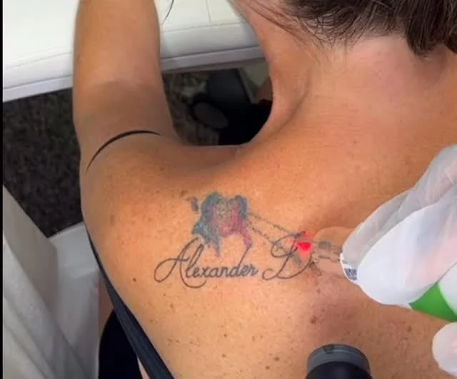 Tattoo Regret!  She wanted shooting stars to complement name and got a blob.  We can fix it. #envisionlasertattooremoval  #portcharlottefl  #sarasota  #northportfl #capecoralflorida