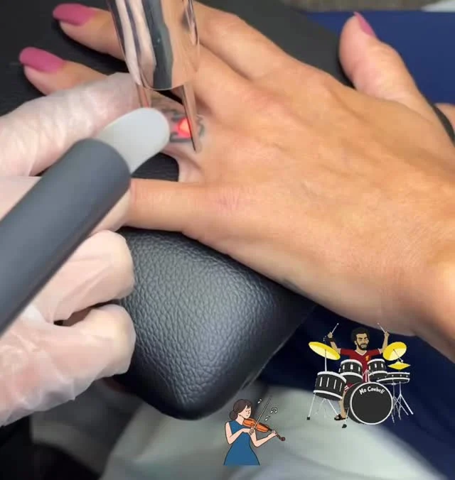 2nd Laser Treatment #envisionlasertattooremoval #sarasota #portcharlottefl #capecoralflorida #veniceflorida