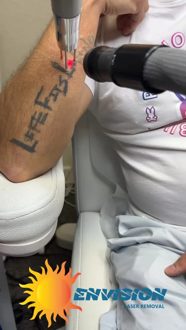 First Laser Treatment, and how #envisionlasertattooremoval supports laser treatment pain. We use Cryotherapy providing -32 Degrees Fahrenheit, the skin cooling too is very effective with #lasertreatmentpain.  We all offer a pause in treatment to support patient comfort.  #portcharlottefl #sarasota #veniceflorida
