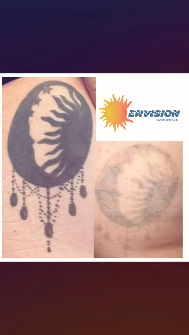 Excellent start to a full tattoo removal? #envisionlasertattooremoval #tattooremovalbeforeandafter #portcharlottefl #northportfl #sarasota