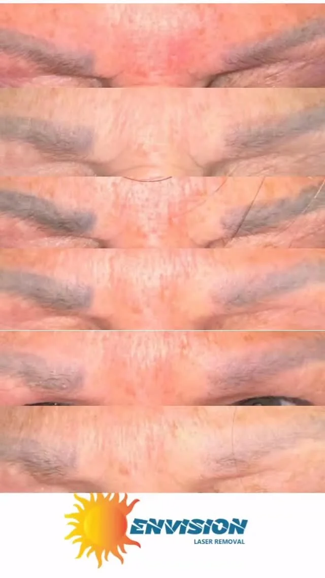 8 installments of Permanent Makeup, Skin Color Coverups (using peach and white ink), Inappropriate Ink Depth, To Much Color, Wrong Color, Oxidation.
6 laser treatments so far.  #envisionlasertattooremoval #permanentmakeupremoval #portcharlottefl #sarasota #capecoralfl