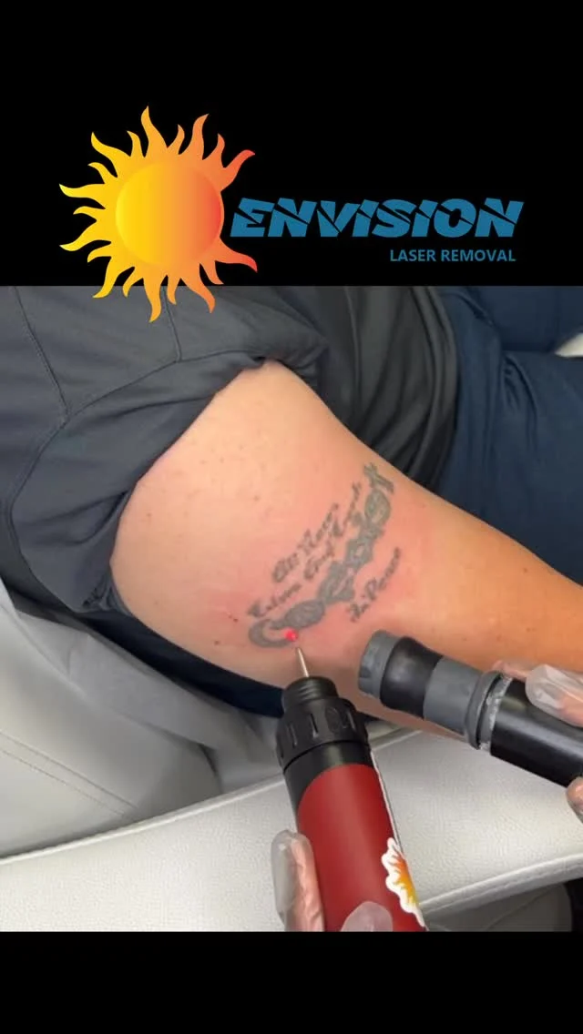 3rd Laser Treatment #envisionlasertattooremoval #portcharlottefl #sarasota #fortmeyers #northportfl