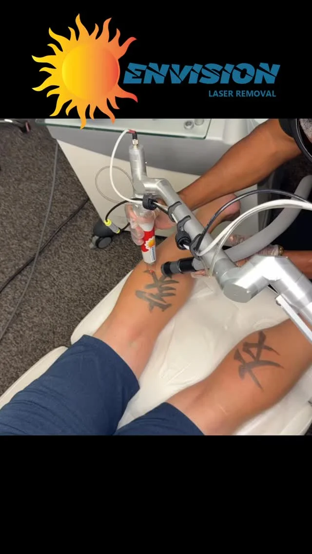 4th Laser Treatment #envisionlasertattooremoval #tattooremovalbeforeandafter #portcharlottefl #sarasota #capecoralflorida