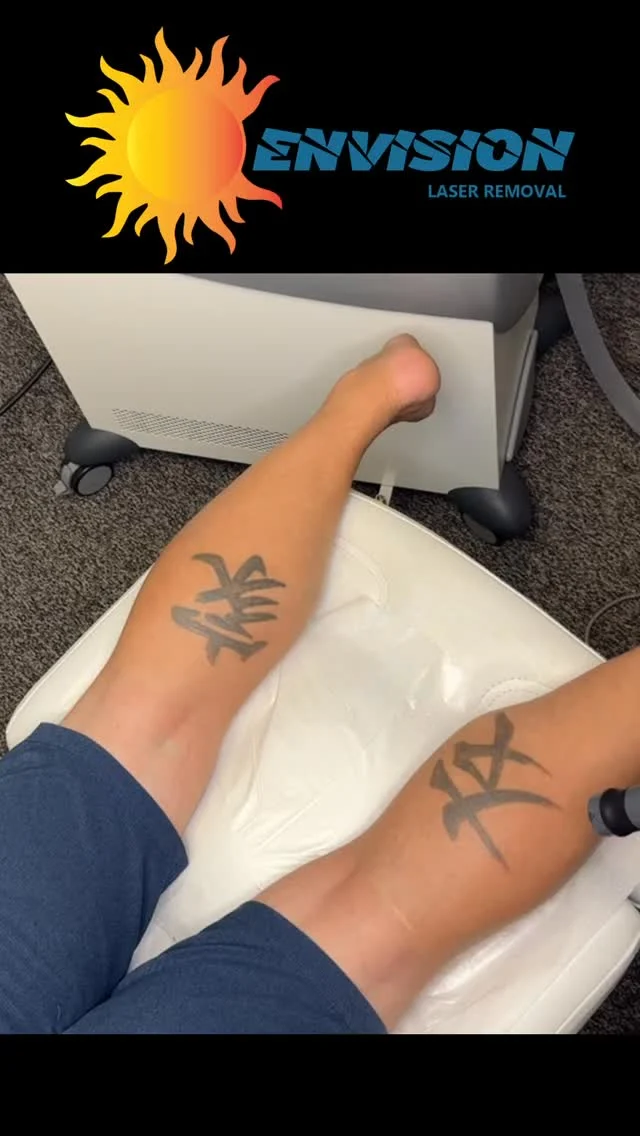 4th Laser Treatment #envisionlasertattooremoval #tattooremovalbeforeandafter #portcharlottefl #sarasota #capecoralflorida